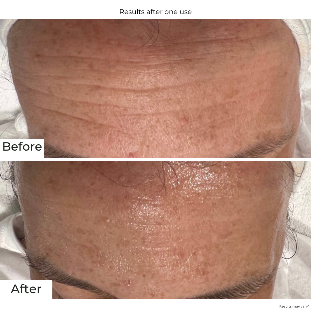 Le Mieux Hyaluronic Serum forehead wrinkles before after