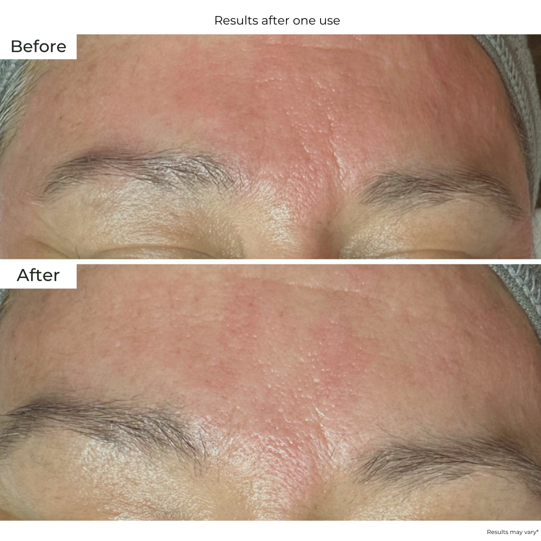  Boto-Needle Frown Line Patch from Le Mieux Skincare - 4